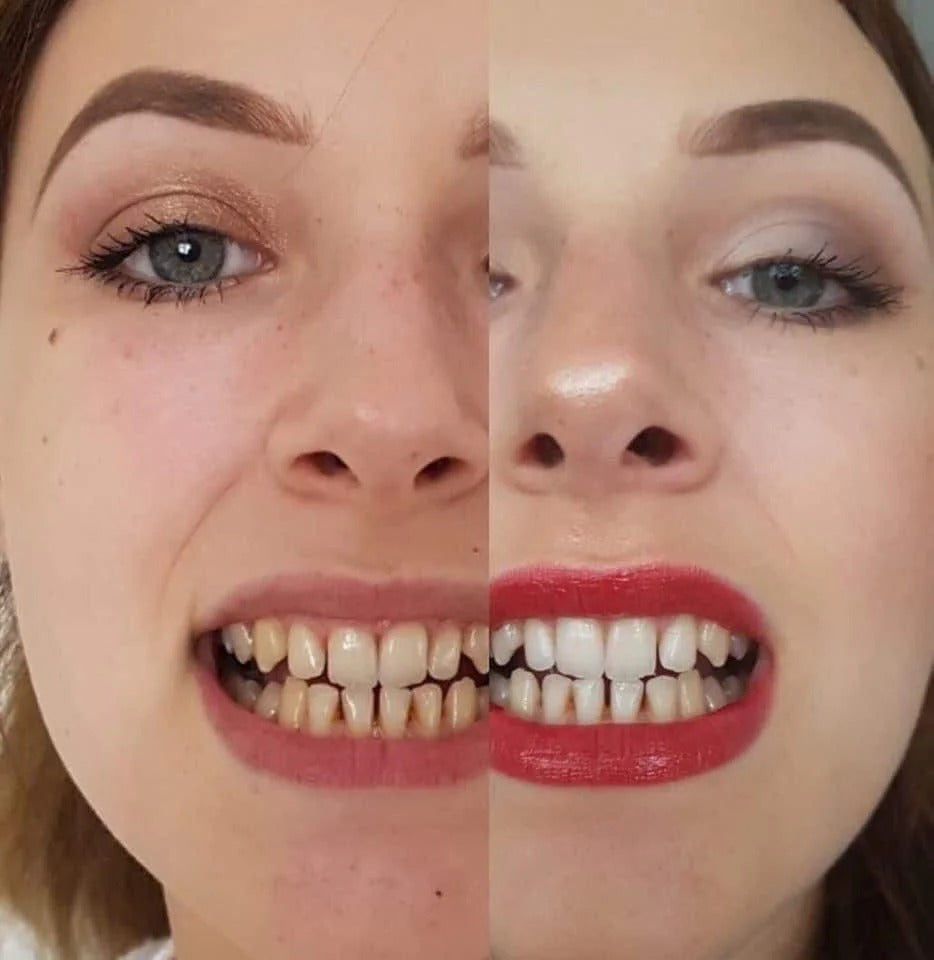 Lápiz BLANQUEADOR DE DIENTES [Compra 1 y llévate 2]