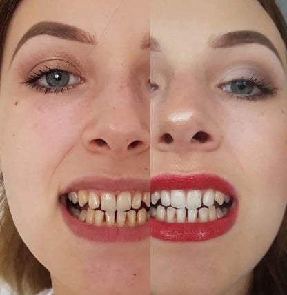 Lápiz BLANQUEADOR DE DIENTES [Compra 1 y llévate 2]